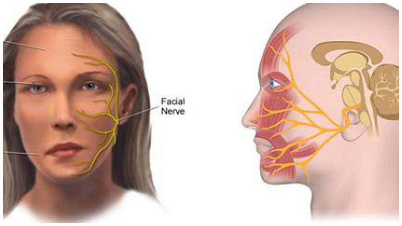 ¿Parálisis facial? Esto es todo lo que tienes que saber sobre esta afección