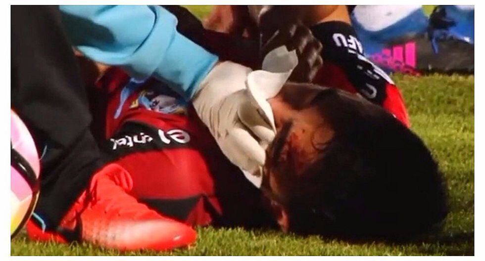 Futbolista chileno recibe brutal patada en la cara y termina con la mandíbula rota (VIDEO)
