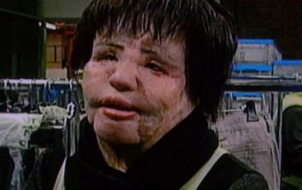 Así quedó exmodelo por obsesión a las cirugías