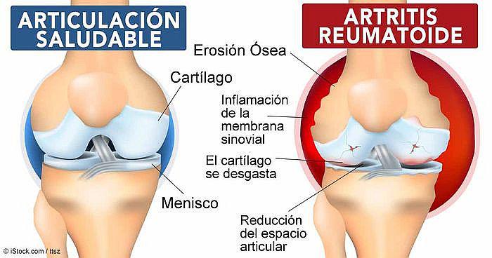 Arequipa: en UCSM descubren cura para la artritis reumatoide