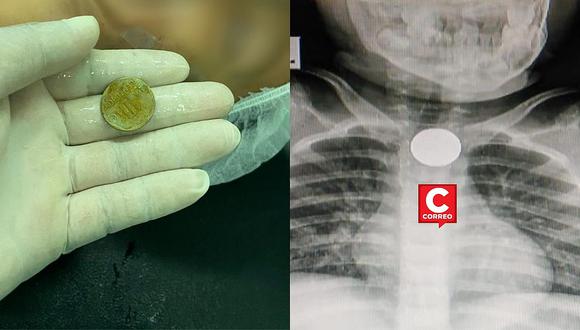 Médicos retiran del esófago una moneda de diez céntimos a un niño de Piura