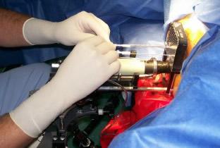 EsSalud realizó el primer tratamiento de Braquiterapia