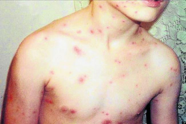 La varicela pasó a ser una enfermedad peligrosa en el Perú