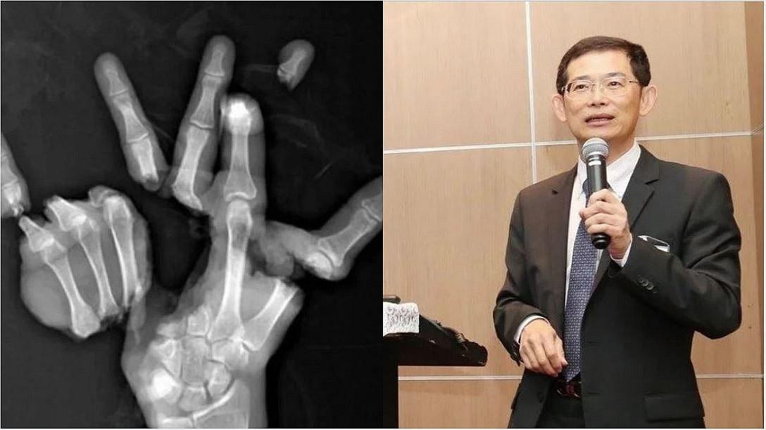 Médico reconstruyó una mano triturada por una máquina