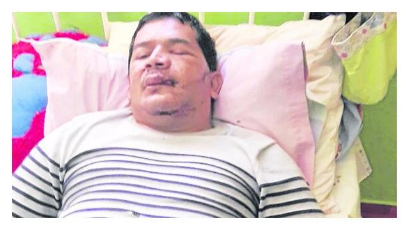 Lambayeque: Vigilante queda desfigurado tras accidente 