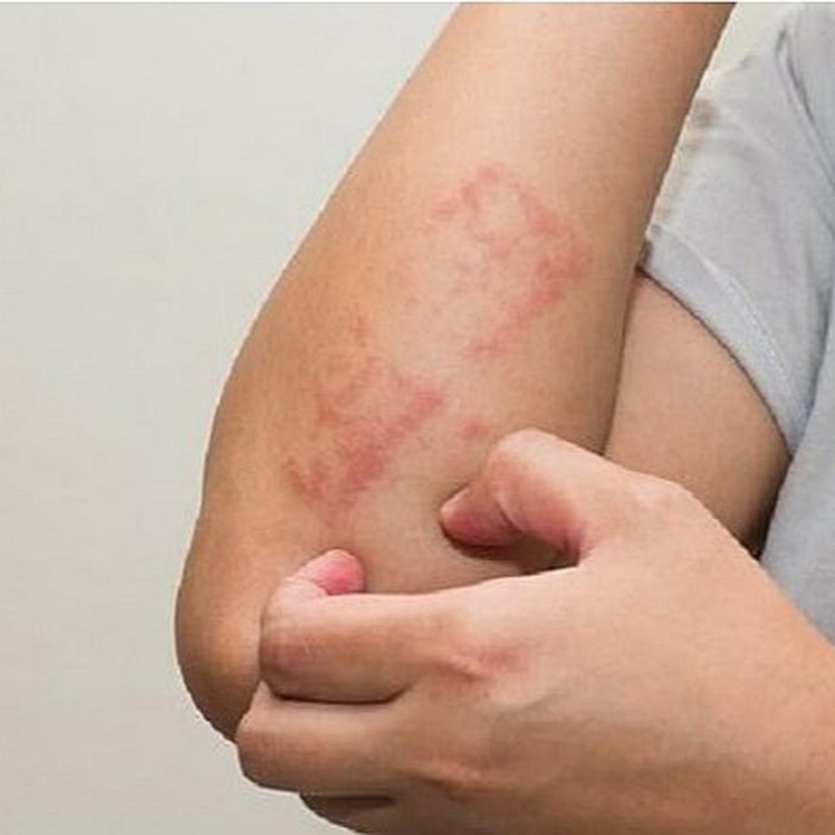 sintomas fisicos de la leucemia