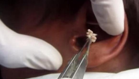  Doctor saca cientos de gusanos de oído de paciente (VIDEO)