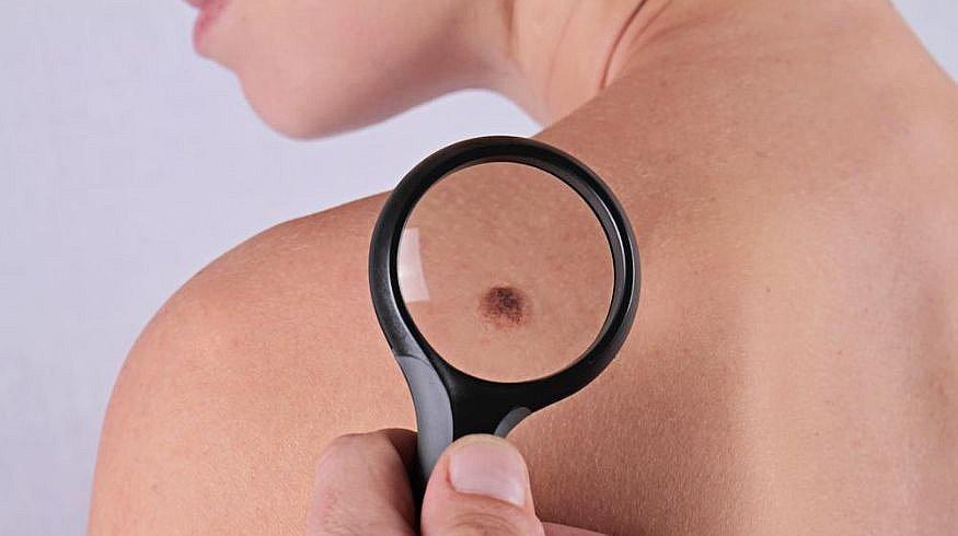  ¿Cómo saber si un lunar es cancerígeno?