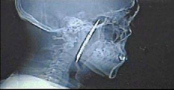 Chino sobrevive cuatro años con un cuchillo en el cráneo