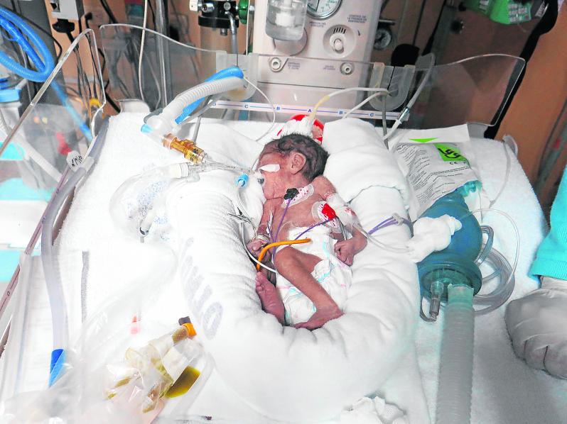 Neumonía ataca a Ángel de Dios bebé que pesa 850 gramos 