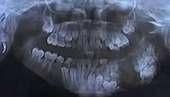 ​Extraen 80 dientes a niño en la India (VIDEO)