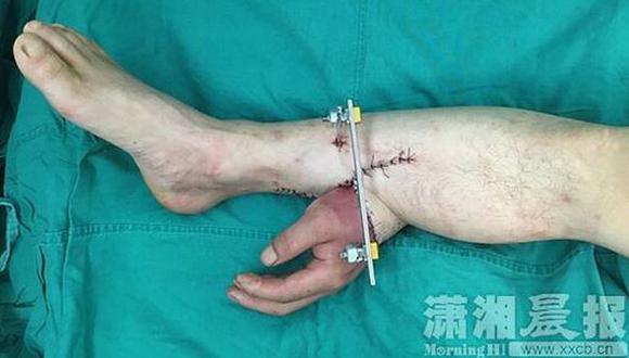 ​China: le implantaron una mano en la pierna para salvarla