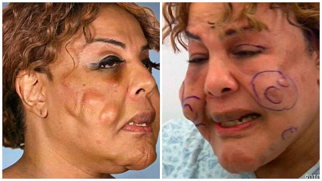 ​Hace once años le inyectaron cemento en la cara y tras una cirugía hoy luce así
