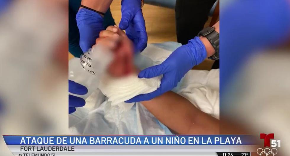 El niño, que fue atacado el jueves mientras nadaba en aguas bajas en una playa de Fort Lauderdale, al norte de Miami (Florida, Estados Unidos), debió ser operado de urgencia al día siguiente. (Captura de video / Telemundo).