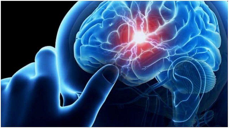 Epilepsia: Desarrollan un estimulador eléctrico cerebral como tratamiento