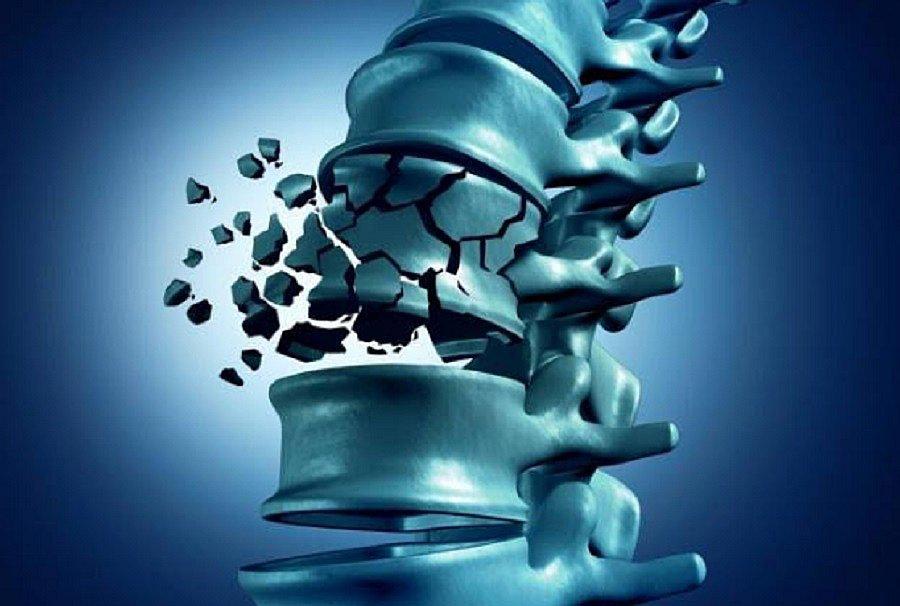 Osteoporosis: Deficiencia de una buena alimentación afecta a los huesos