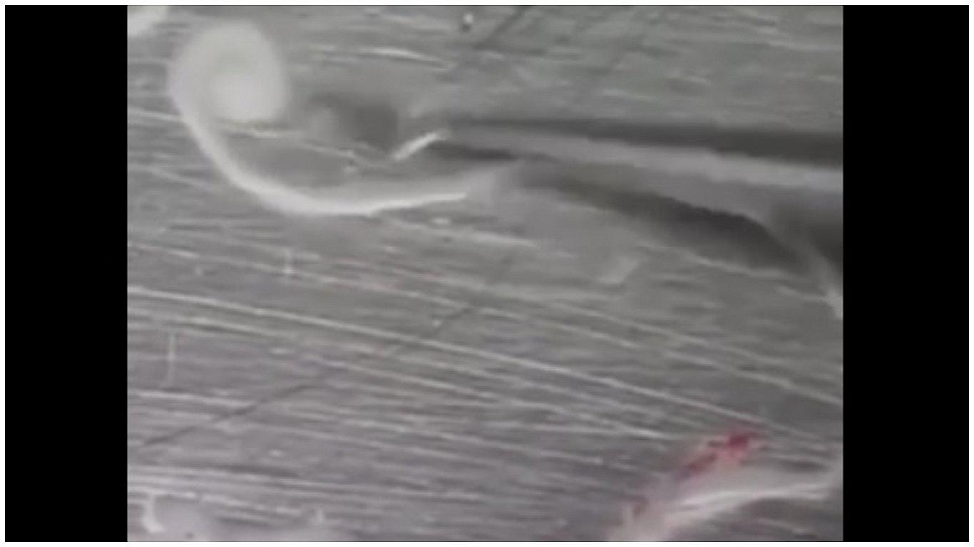 Extirpan tenia que vivió alojada durante 15 años en el cerebro de un hombre 