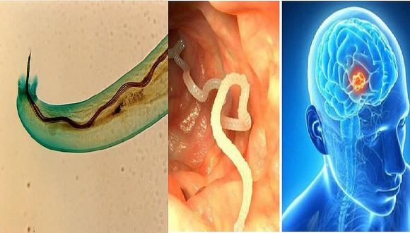 Salud: Alertan sobre peligroso gusano que invade cerebros humanos