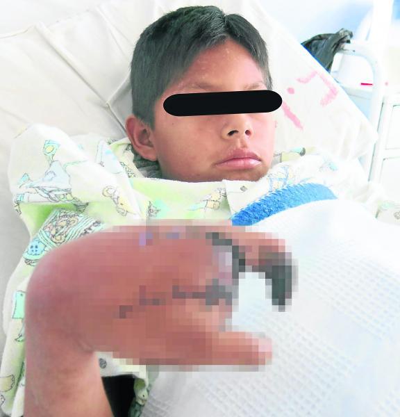 Niño se vuela dos dedos con artefacto pirotécnico 