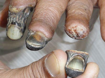 Alarma por la droga 'come carne' que causa la muerte