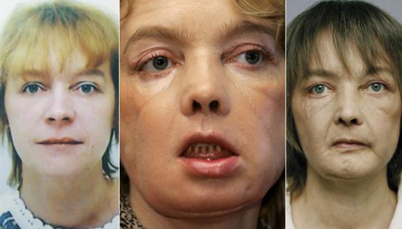Primer paciente de transplante de cara cuenta cómo vive ahora
