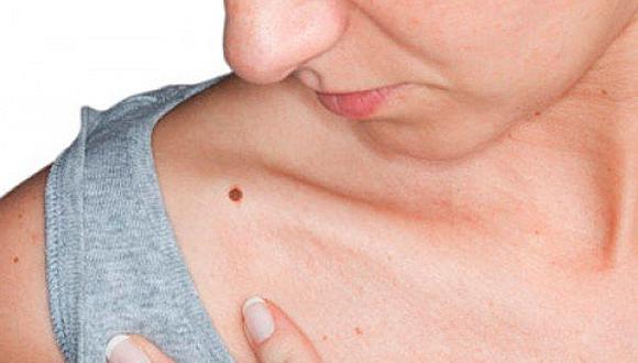​Conozca las señales que podrían indicar un riesgo de cáncer de piel