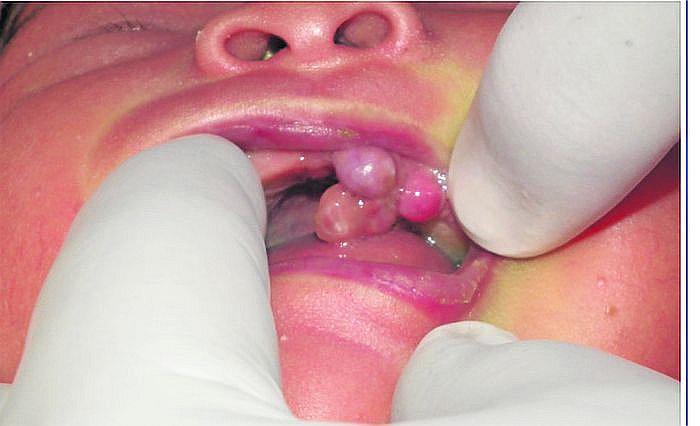 Descubren primer caso de épulis congénito en una recién nacida