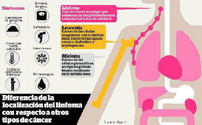 Linfoma folicular: avances de la ciencia permiten tratar este tipo de cáncer