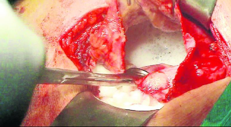 Hombre vivió 30 largos años con quiste