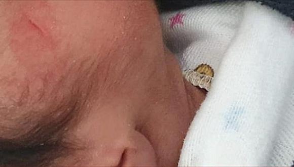 ​EsSalud empezó auditoría médica por corte en el rostro de recién nacida