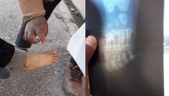 Madre denuncia que bebé de dos años se fracturó el dedo en local de Cuna Más