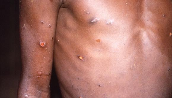 La viruela del mono afecta la piel, como en este paciente de África (Foto: Reuters)