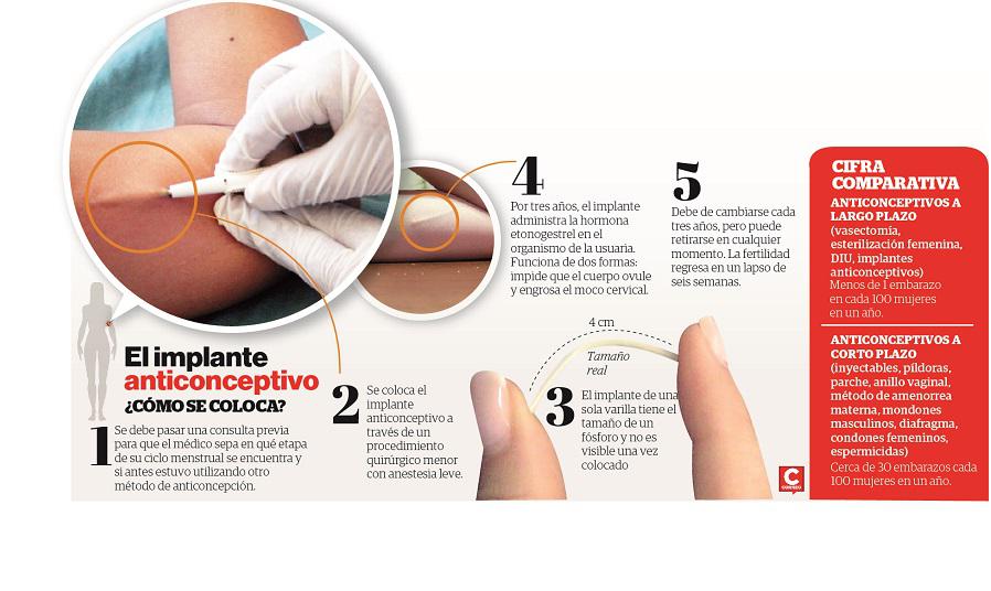 El implante anticonceptivo: Una medida más efectiva y accesible