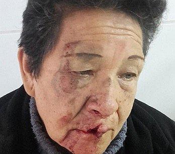 Orate agrede a una anciana y le provoca delicada lesión 