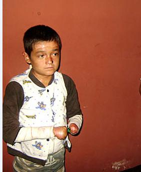 Isaac Pilco niño con 'piel mariposa' fue operado con éxito en Chile 