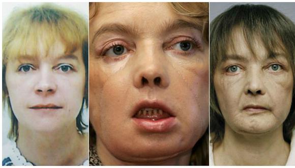 Francia: Muere mujer que recibió el primer trasplante mundial de cara 