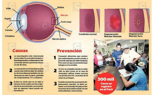 Maculopatía afecta a 300 mil peruanos. Sepa todo sobre esta enfermedad en esta nota