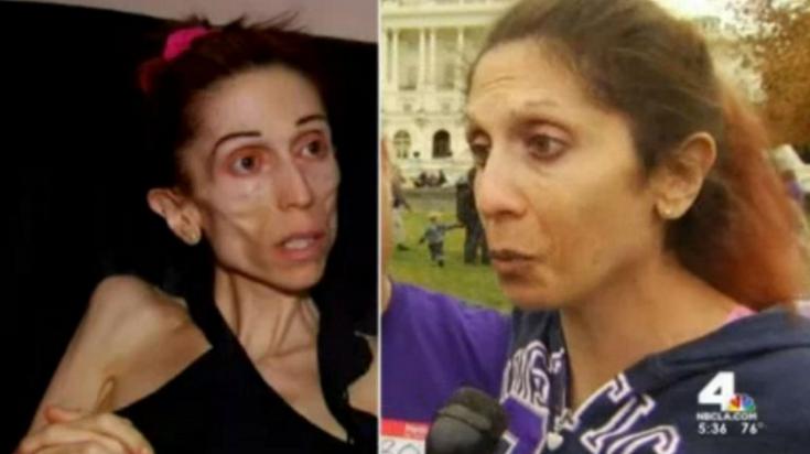 Actriz anoréxica que pesaba 18 kilos se recupera de manera increible