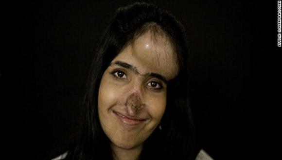 La joven mutilada por talibanes se recupera y sonríe a la vida 