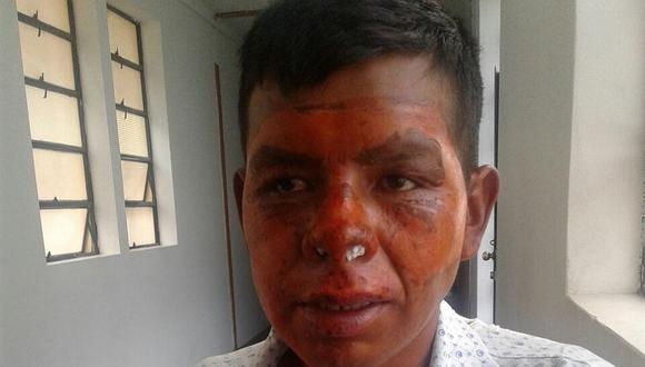 Poblador acoriano sufre quemaduras en explosión  provocada por fuga de gas