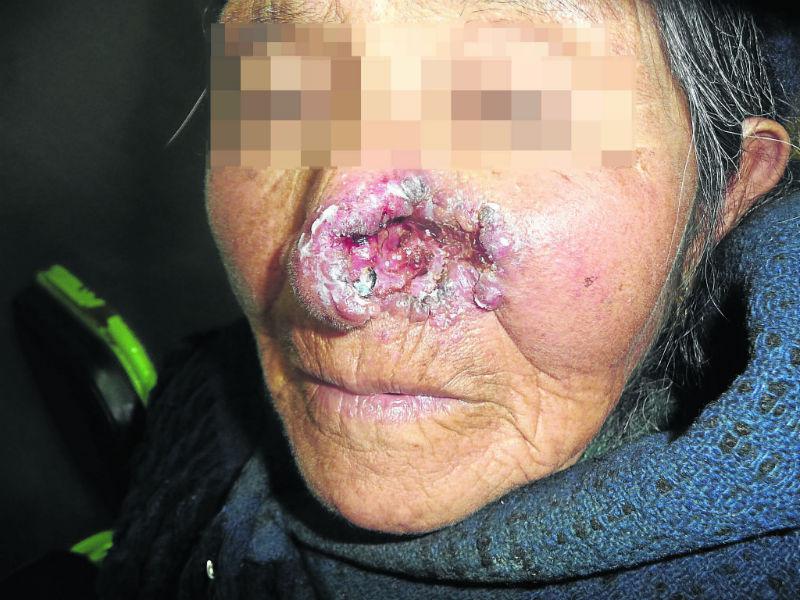 Ancianos agricultores son mas aquejados por el cáncer de piel