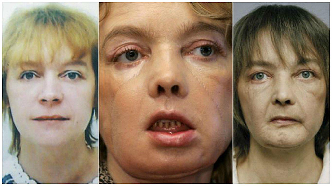 Francia: Muere mujer que recibió el primer trasplante mundial de cara 