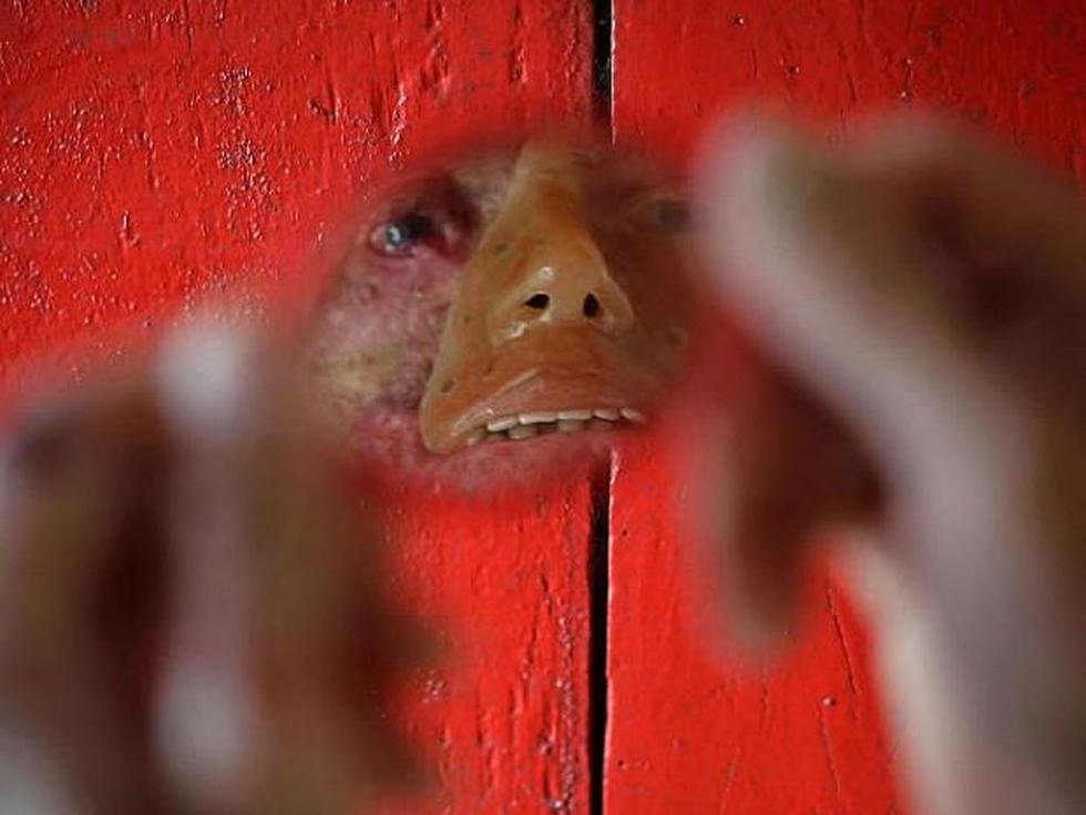 Brasil: Investigan enfermedad que deja sin piel a los habitantes de un pueblo