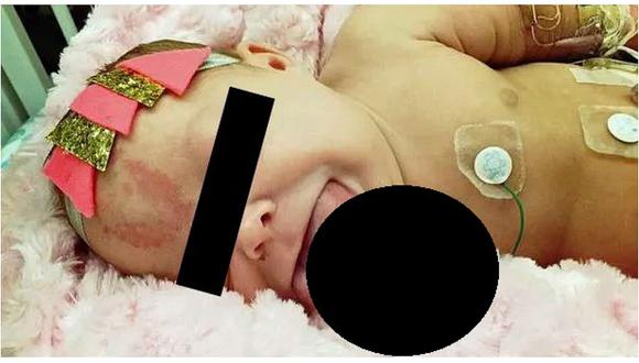 Bebé que nació con lengua muy grande luce así tras exitosa cirugía (FOTOS)