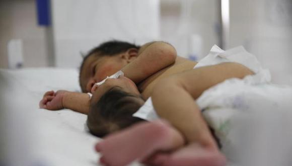 India: Nace bebé con segunda cabeza unida a su estómago