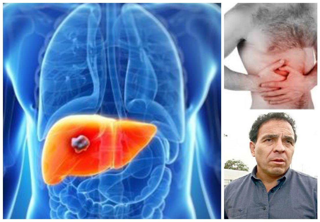 Salud: Conoce los signos y síntomas del cáncer de hígado