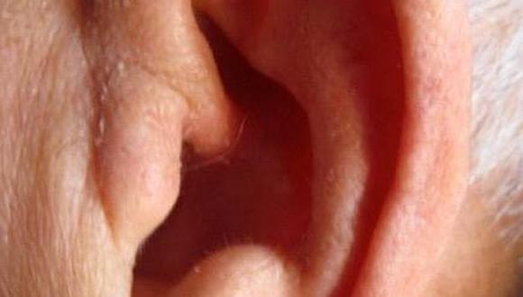Un pliegue en tu oreja te advierte del riesgo de padecer un infarto