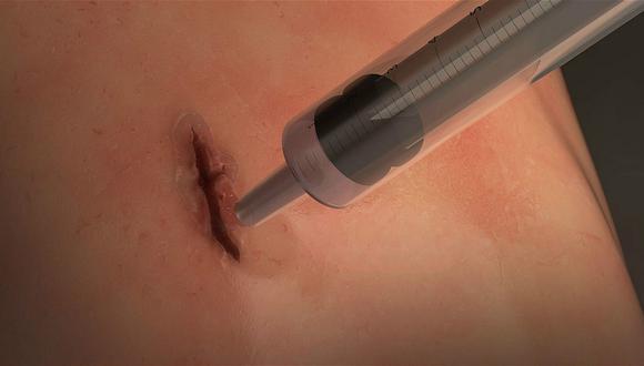 Bioingenieros crean el primer "pegamento" para cerrar heridas en la piel (VIDEO)