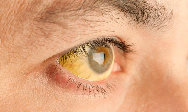 La hepatitis B es cien veces más contagiosa que el SIDA