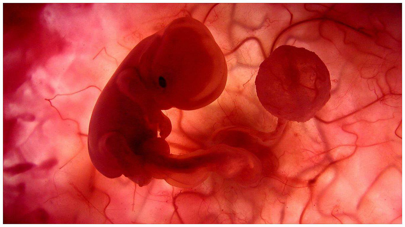 Zika podría causar abortos o tejido cerebral blando en bebés, según estudio